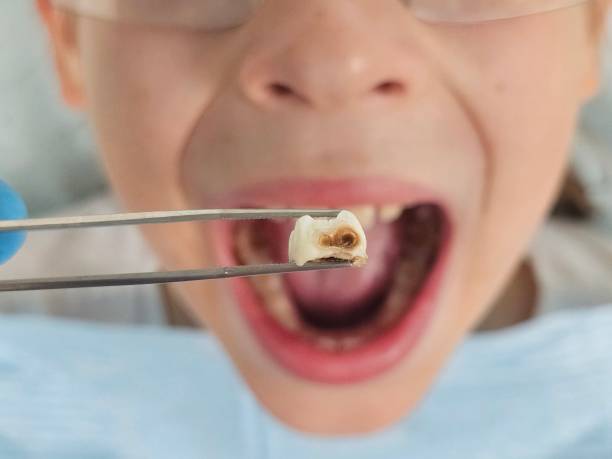 Best Chipped Tooth Repair Near Me  in Chimayo, NM